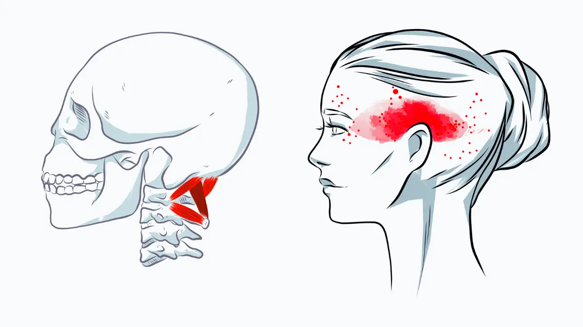boyun fıtığı ve baş ağrısı