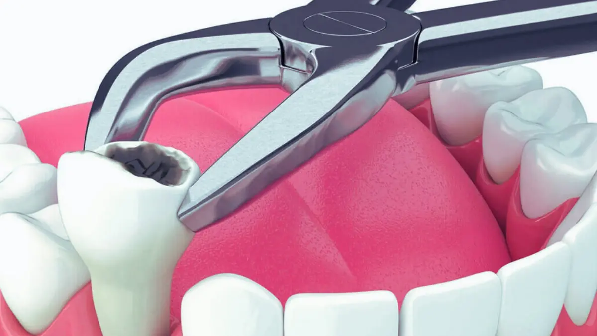 diş çekimi sonrası ağrı