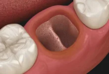 dişimi çektirdim hala ağrıyor ne yapmalıyım