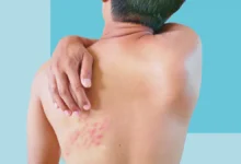 geçmeyen zona ağrısı