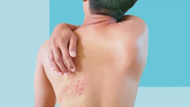 geçmeyen zona ağrısı