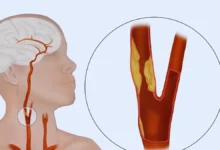 şah damarı tıkanıklığı ve ağrısı